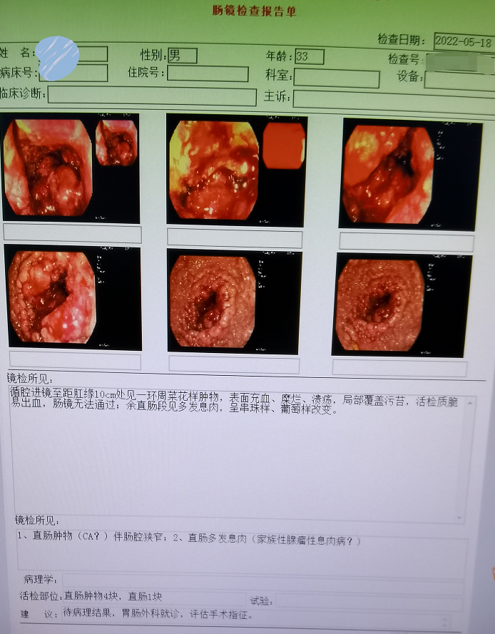 福州20多岁男子患肠癌，10多岁妹妹也没躲过……这种肠息肉会遗传！