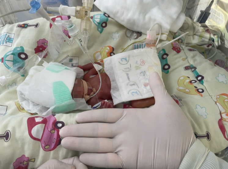 福州双胞胎“巴掌宝宝”出生不足1斤，142天闯关成功！