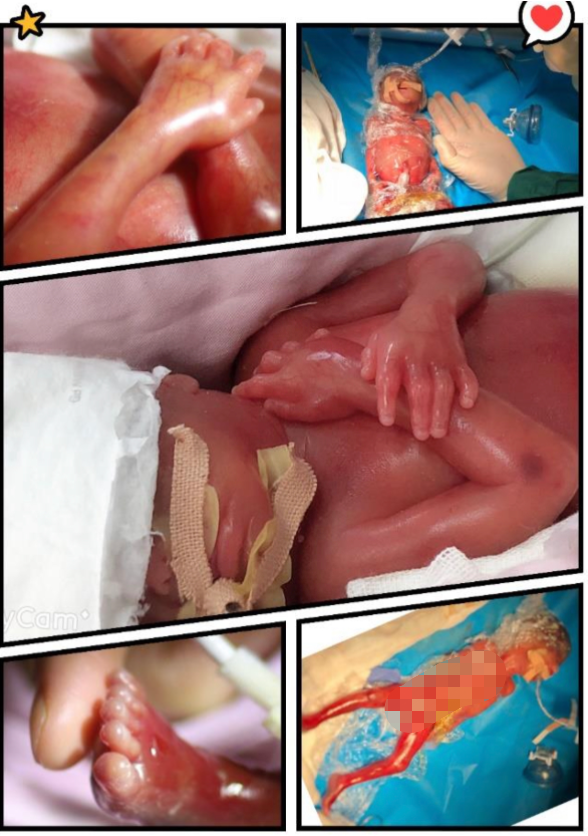 福州双胞胎“巴掌宝宝”出生不足1斤，142天闯关成功！