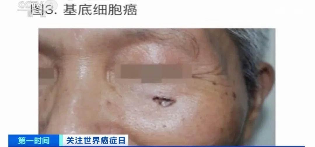 这种癌症发病率高，极易被忽视，常被误认为老年斑