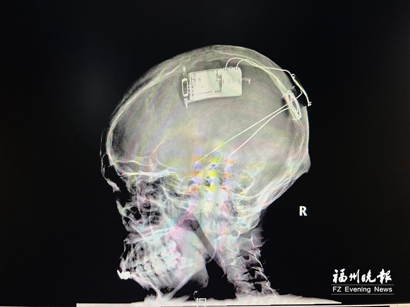 协和医院完成华南地区首例脑机接口手术 神经调控器植入脑中治癫痫
