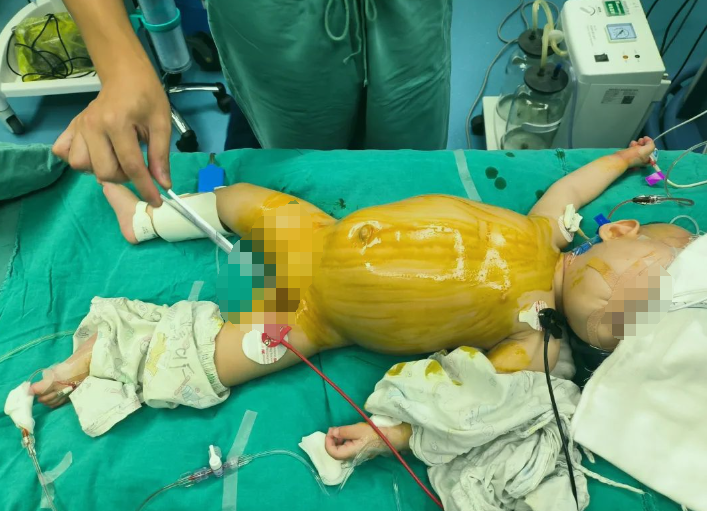 仅16斤女婴肚子暗藏5斤多重肿瘤，福州医生创下生命奇迹