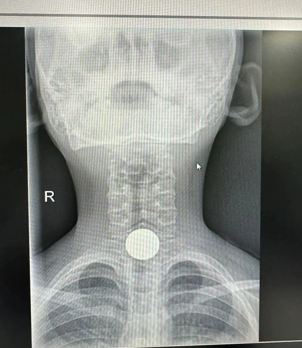 9岁男童误吞硬币卡食道！长乐医生用这个办法……