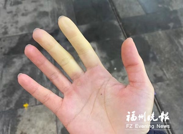 小伙手指遇冷会变色 原来是患上了罕见的硬皮病