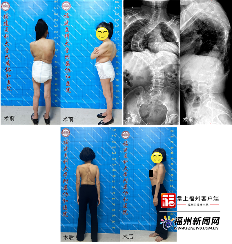 女子脊柱侧弯高达91° 手术治疗后竟增高10cm