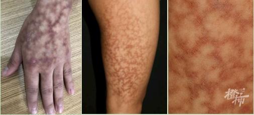 70多岁老人贴身捂热水袋捂出蟒蛇纹