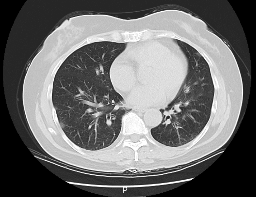大S真实死因有变？专家释疑！近期已有不少人进了医院，医生：别硬扛……