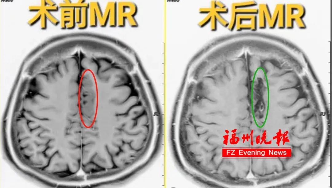 不是夢(mèng)游,！福州21歲女孩睡覺(jué)時(shí)拳打腳踢！一查竟是……