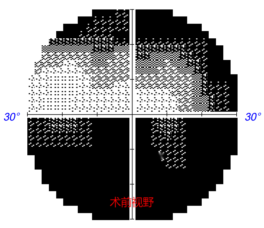 免开颅之险！男子车祸后眼前呈现“马赛克”，经鼻腔微创手术为其重启清晰“视”界