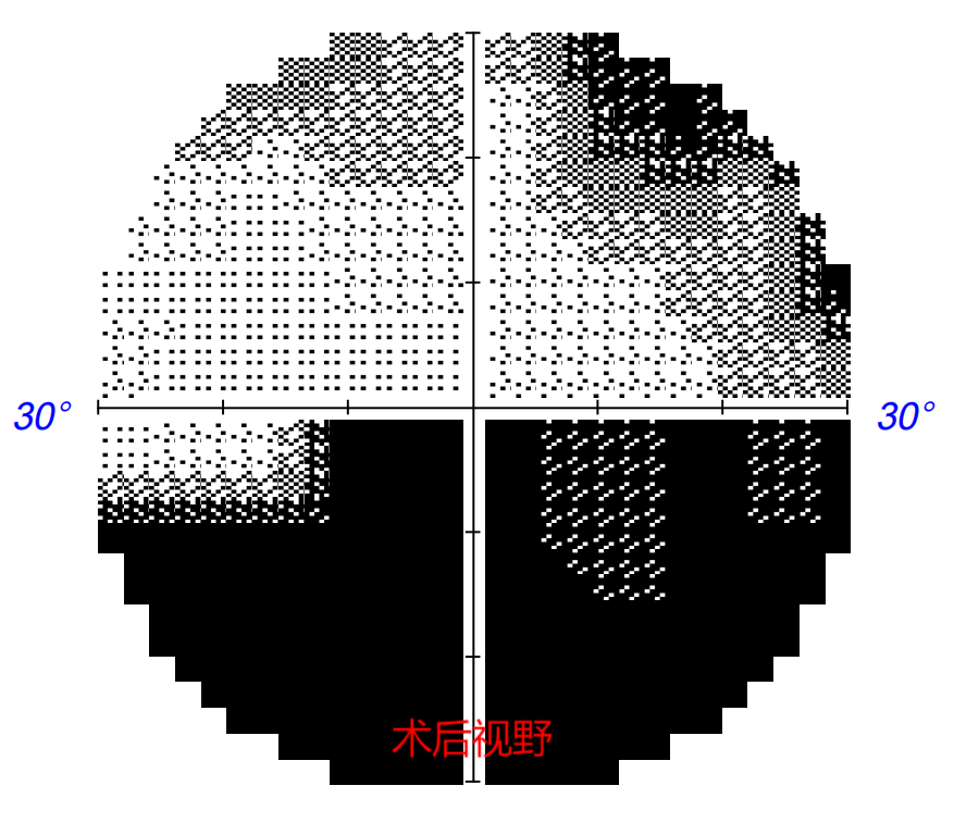 免开颅之险！男子车祸后眼前呈现“马赛克”，经鼻腔微创手术为其重启清晰“视”界