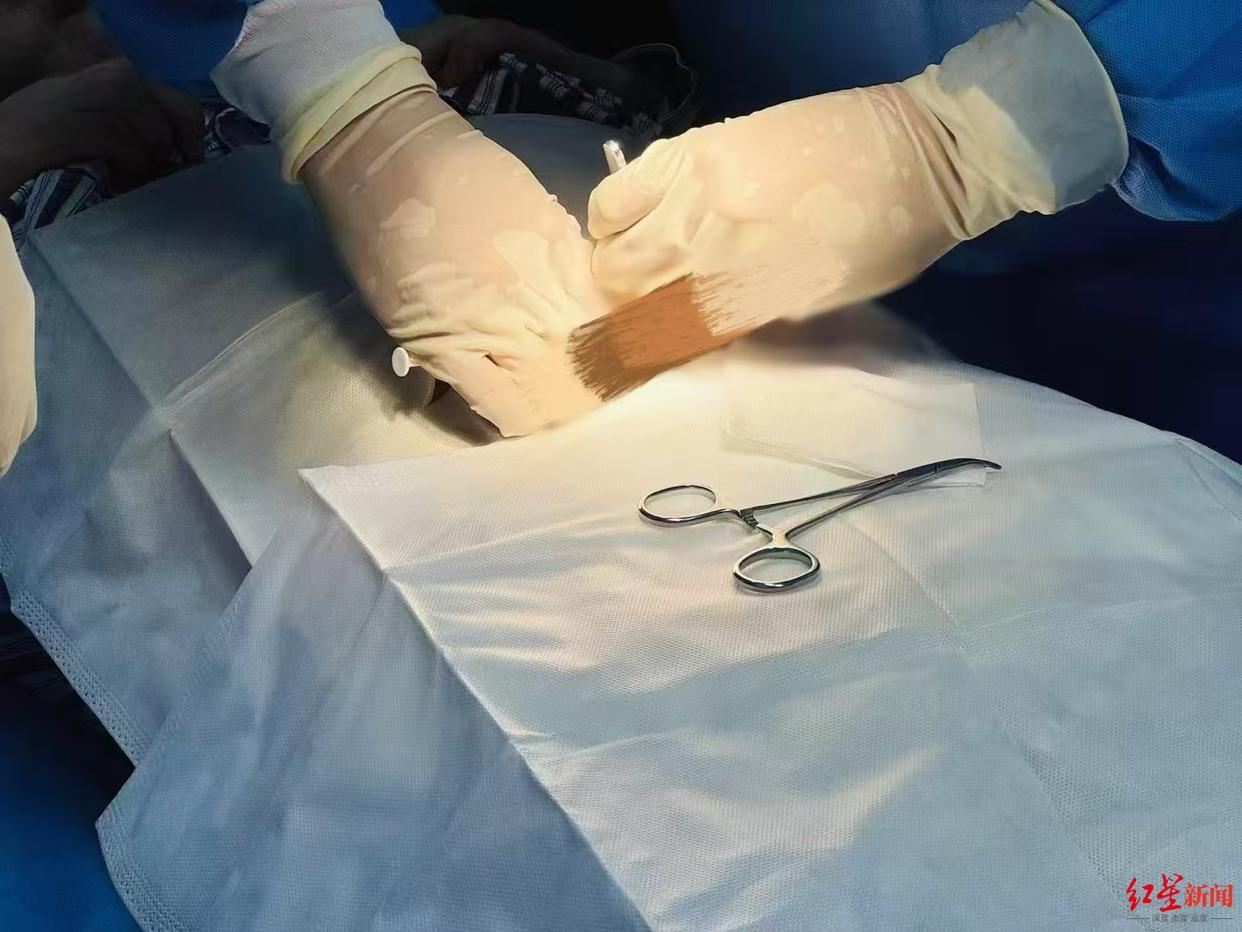 女子植入戒酒芯片称酒就像白开水