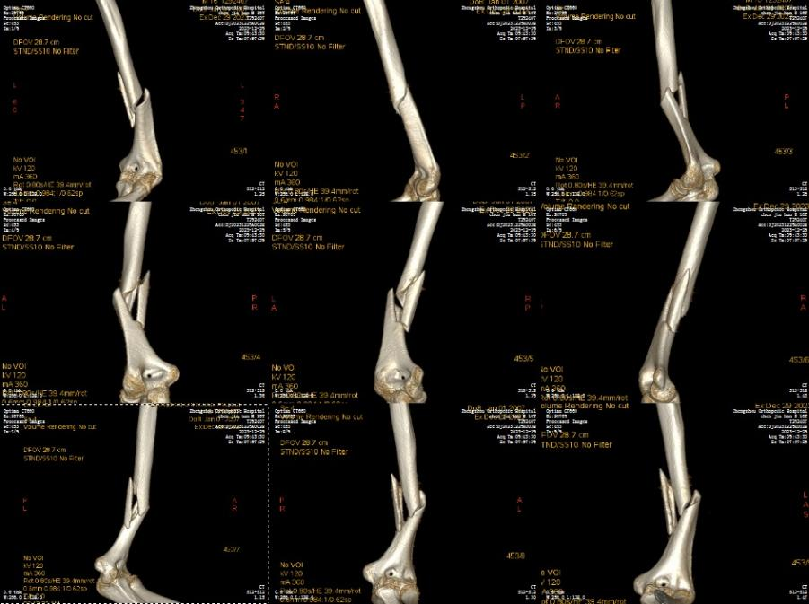 咔嚓一声，胳膊断了！这种游戏别太“上头”……