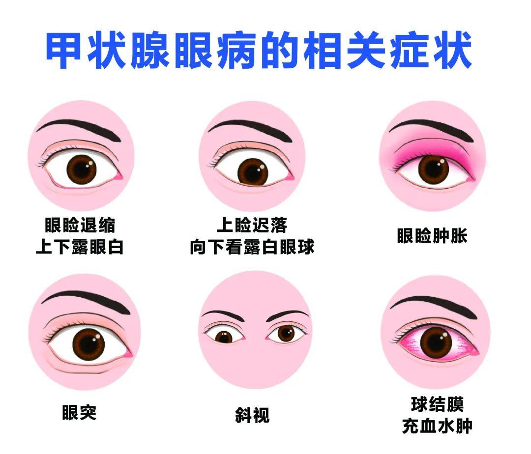 福建首家引进中国首款甲状腺眼病靶向药，福州爱尔眼科医院甲状腺眼病治疗手段进一步丰富