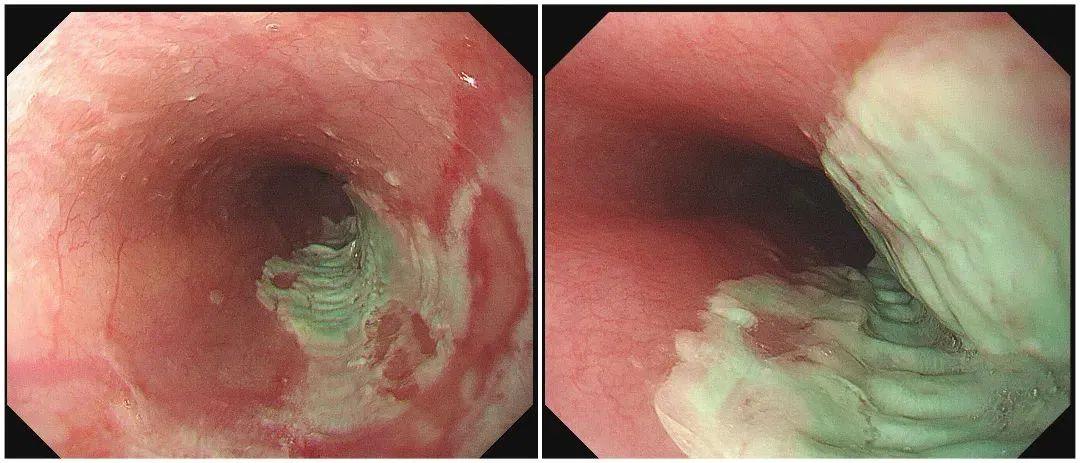 男子食道长满“刀口”，只因一个错误习惯……
