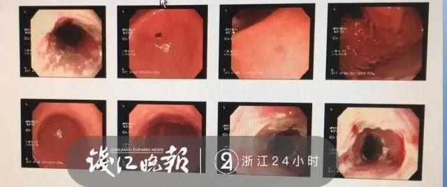 男子食道长满“刀口”，只因一个错误习惯……
