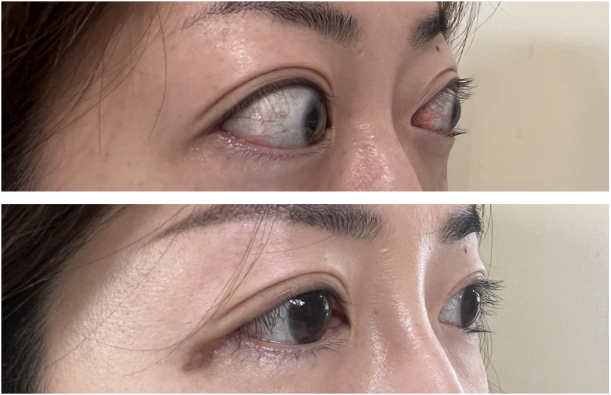 福建高发！27岁女教师双眼暴突闭不上，泪流不止，竟是因这些习惯……