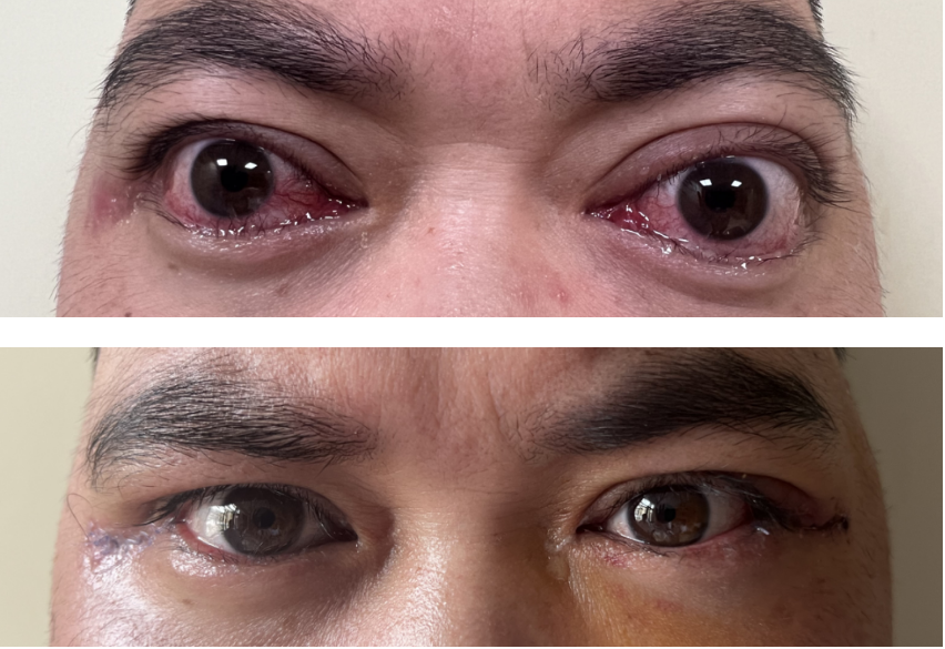 福建高发！27岁女教师双眼暴突闭不上，泪流不止，竟是因这些习惯……