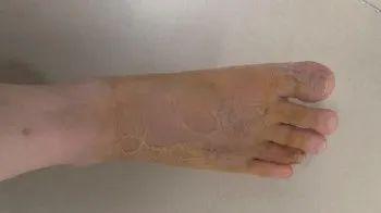 沙发上睡一觉被虫咬，差点截趾！严重或危及生命，千万当心！