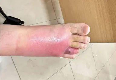 沙发上睡一觉被虫咬，差点截趾！严重或危及生命，千万当心！