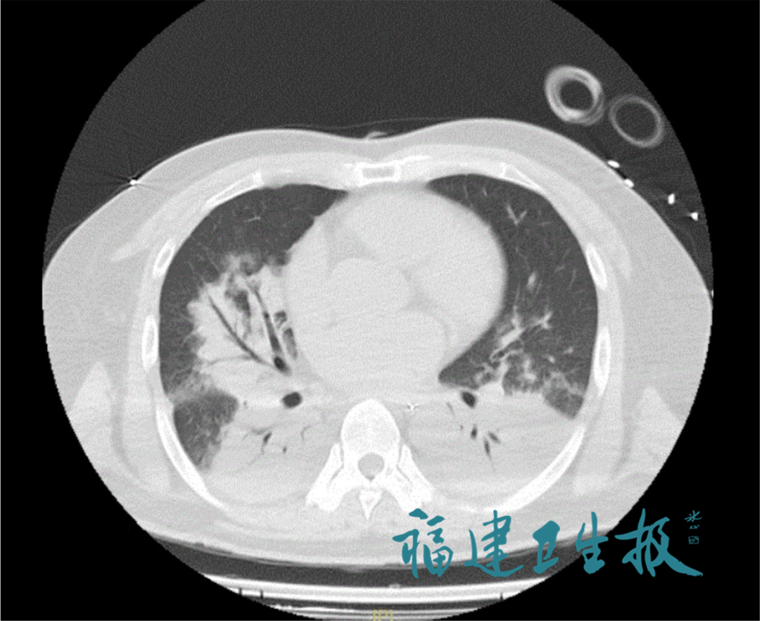 生命垂危！福建男子吹空调后高烧不退，肺都“白”了