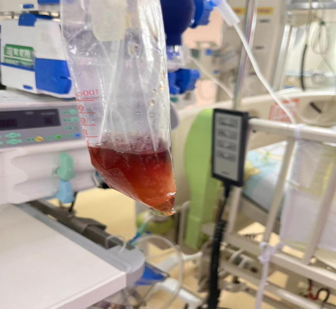 广东5岁男孩吃1包坚果住进ICU 只因含有“它”