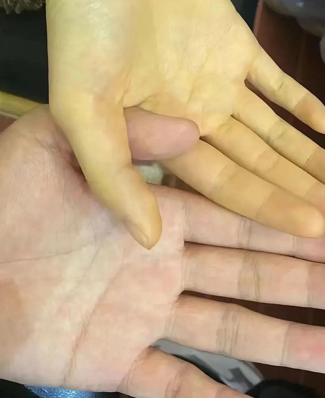 广东5岁男孩吃1包坚果住进ICU 只因含有“它”