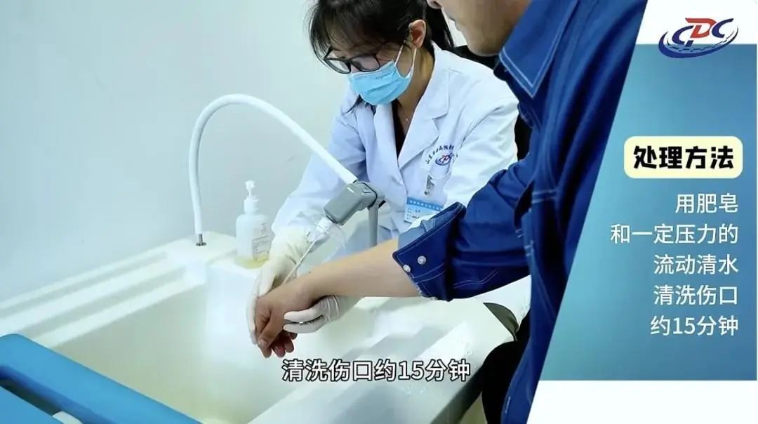 被狗咬未就医 3个月后发病去世