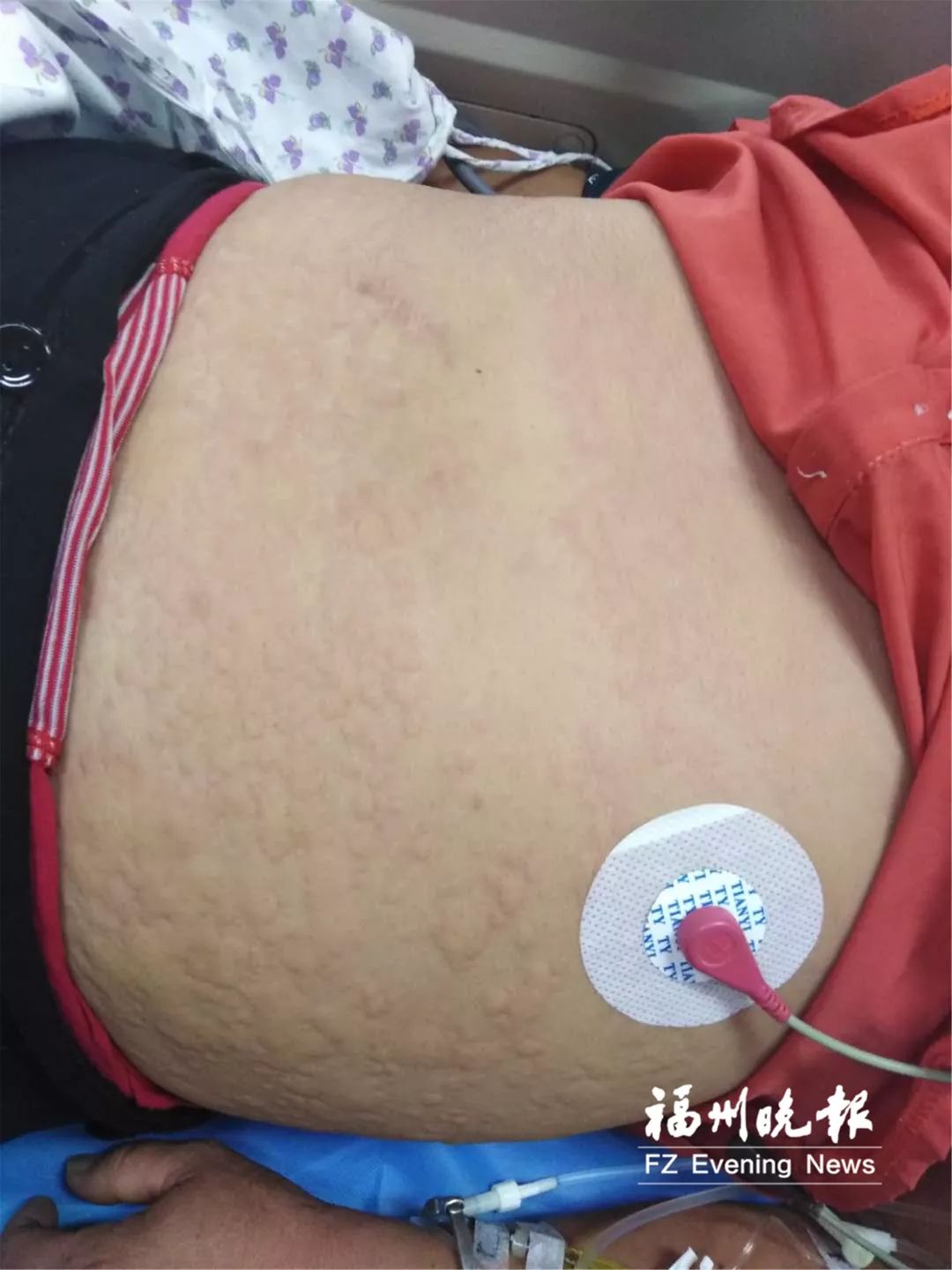 不要碰！发现立即上报！福州有人被咬伤！