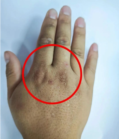 不要碰！发现立即上报！福州有人被咬伤！