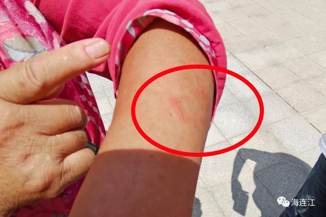 不要碰！发现立即上报！福州有人被咬伤！