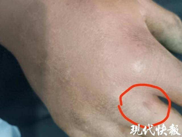 男子被毒蛇咬伤 网友隔空提醒救命