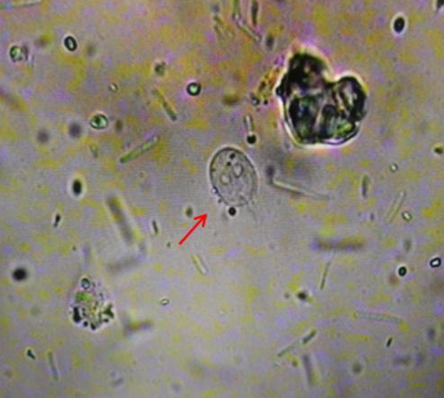持续腹泻、发热！福州一小伙感染“鬼脸虫”