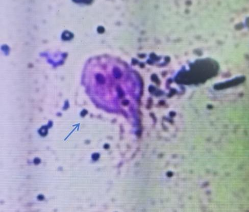 持续腹泻、发热！福州一小伙感染“鬼脸虫”