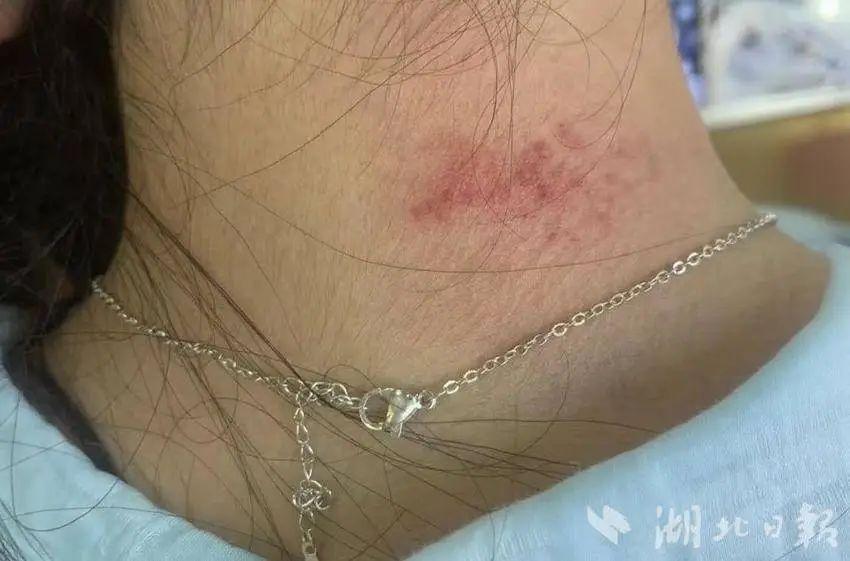 高毒性重金属超标，有人已中招！提醒：夏季高发，不要长时间接触