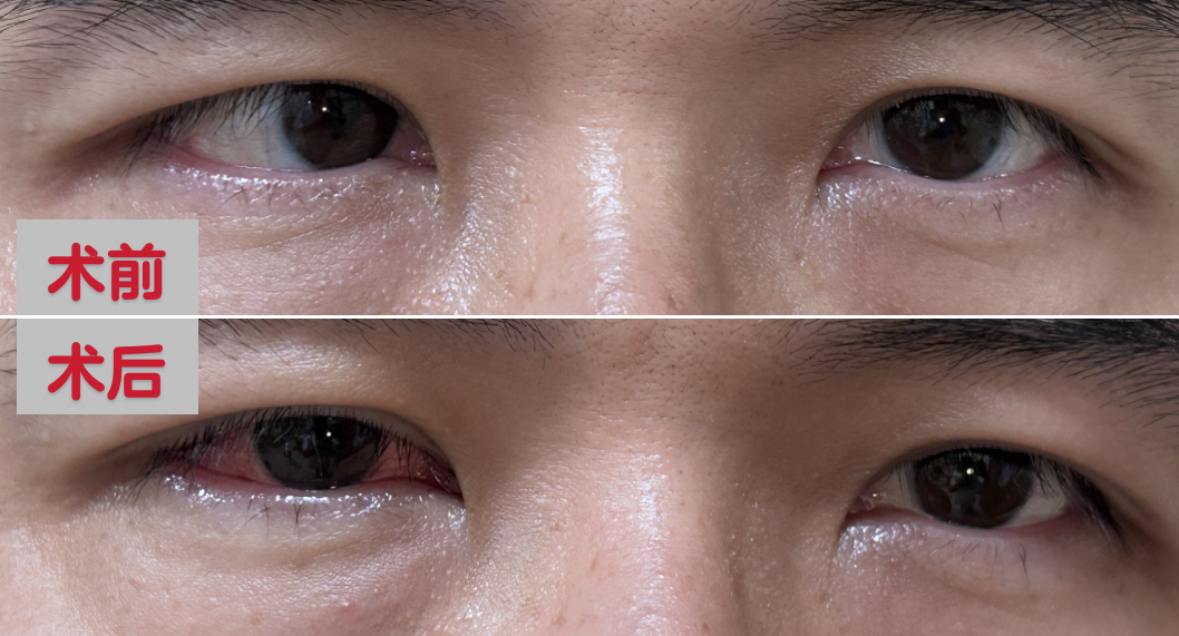 男子假期猛刷手机刷出“斗鸡眼”，看东西重影！医生：避免高强度近距离用眼