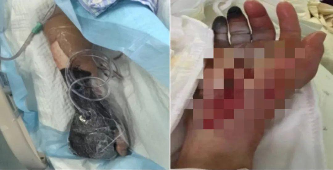 6岁男童沙滩光脚，踩到死鱼后进了ICU！医生紧急提醒！