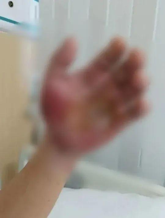 6岁男童沙滩光脚，踩到死鱼后进了ICU！医生紧急提醒！