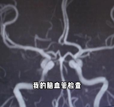 45岁三甲医院脑梗专家自己脑梗了