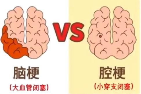 45岁三甲医院脑梗专家自己脑梗了
