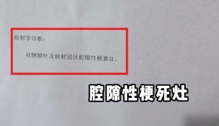 45岁三甲医院脑梗专家自己脑梗了