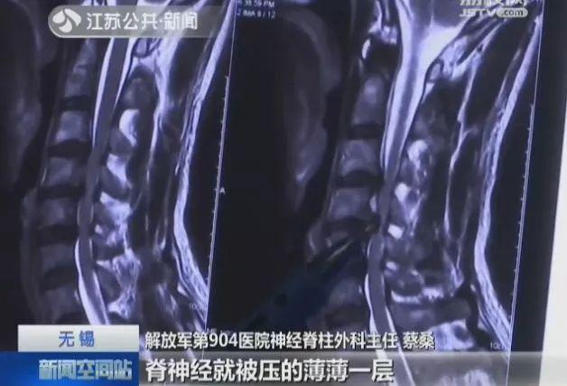 福建19岁小伙突然瘫痪!医生:这个常见动作害了很多人! 福建19岁小伙突然瘫痪!医生:这个常见动作害了很多人!