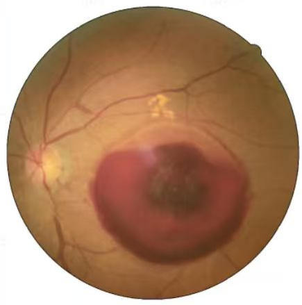 “手术非常及时，第一次遇到服务这么好的医院！”七旬老伯异地求医收获满满感动