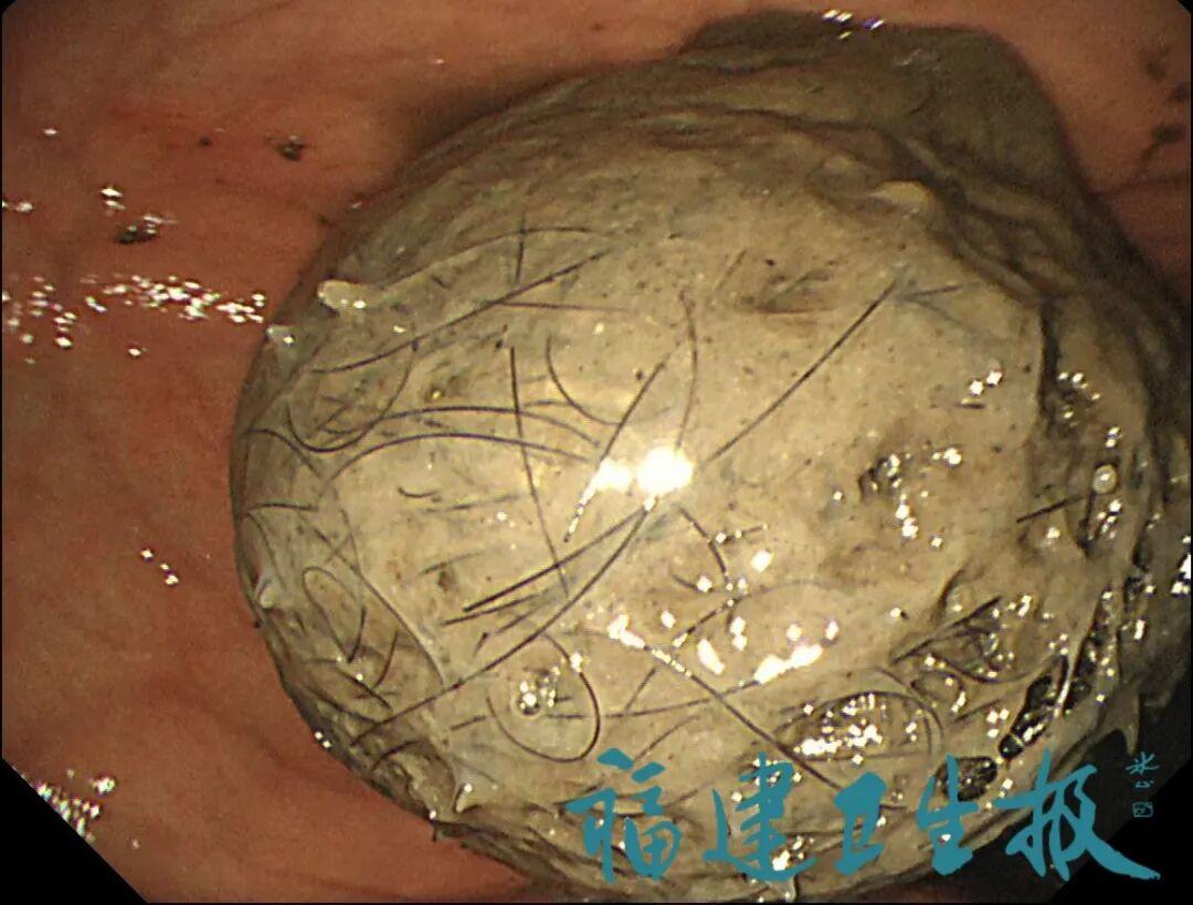 福州10岁女孩长期腹痛，医生一查傻眼：从肚子里取出两大盆！