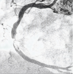 警惕心梗！福州一男子险丢命！