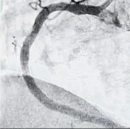 警惕心梗！福州一男子险丢命！