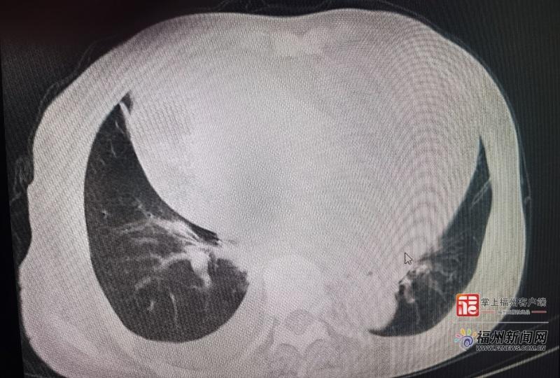 ​老人不明原因乏力、食欲下降？专家提醒：这可能是无声警报