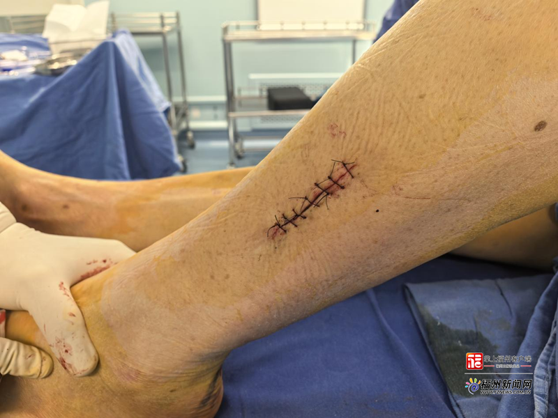 好医声｜福州一大爷双脚麻木误认老毛病 专家提醒：可能是病变信号