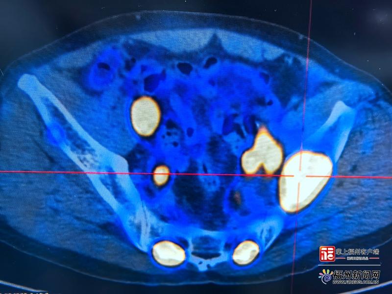 全省首例！晚期前列腺癌精准“核导弹”治疗在榕成功实施
