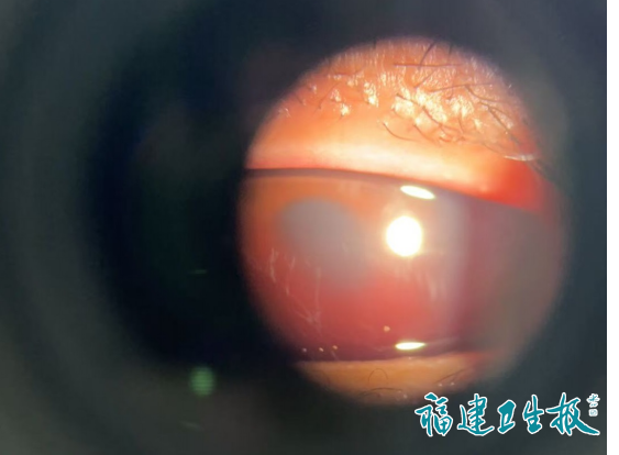 不是个例！福建有人眼球当场破裂，全是因……医生提醒：元宵节前后高发！