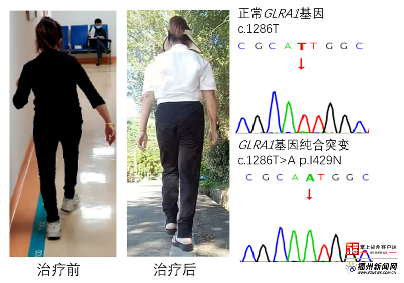 行走不稳、易跌倒是“脑瘫”？也有可能是“罕见病”